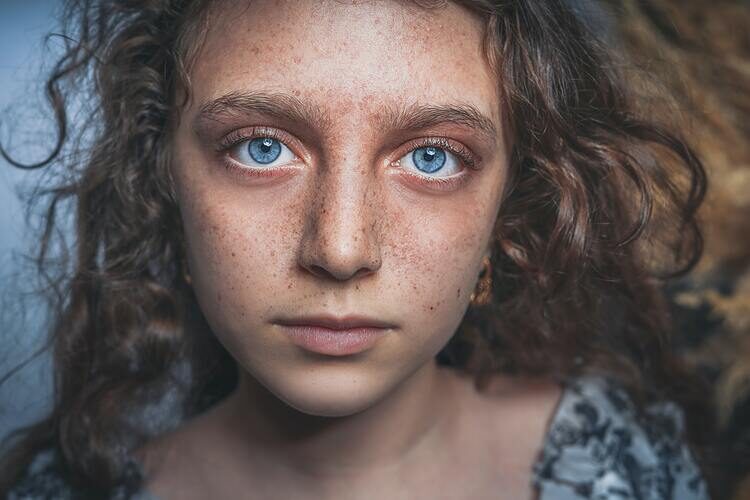 girl with acne